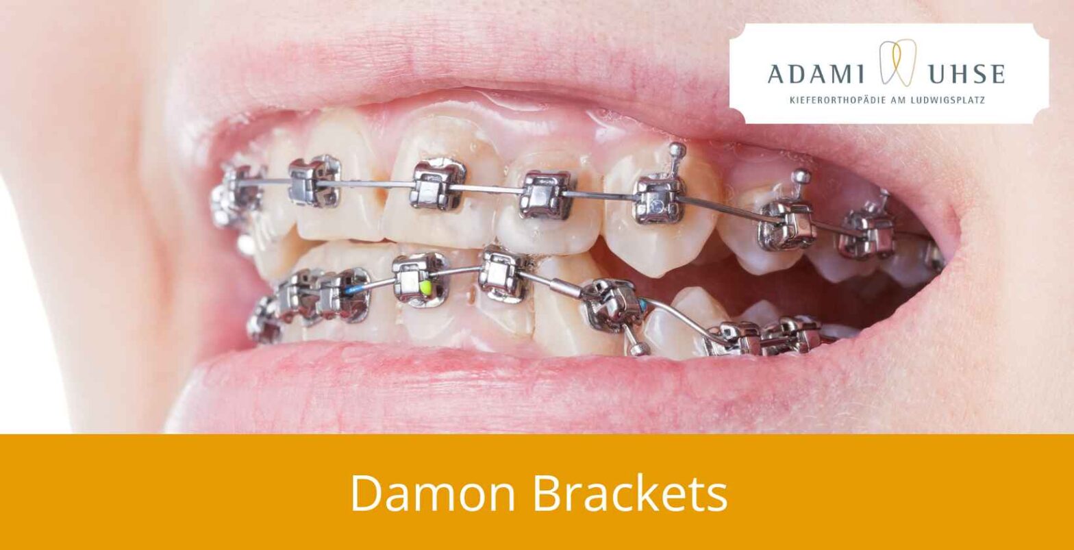 Damon Brackets: Definition, Vorteile und Nachteile